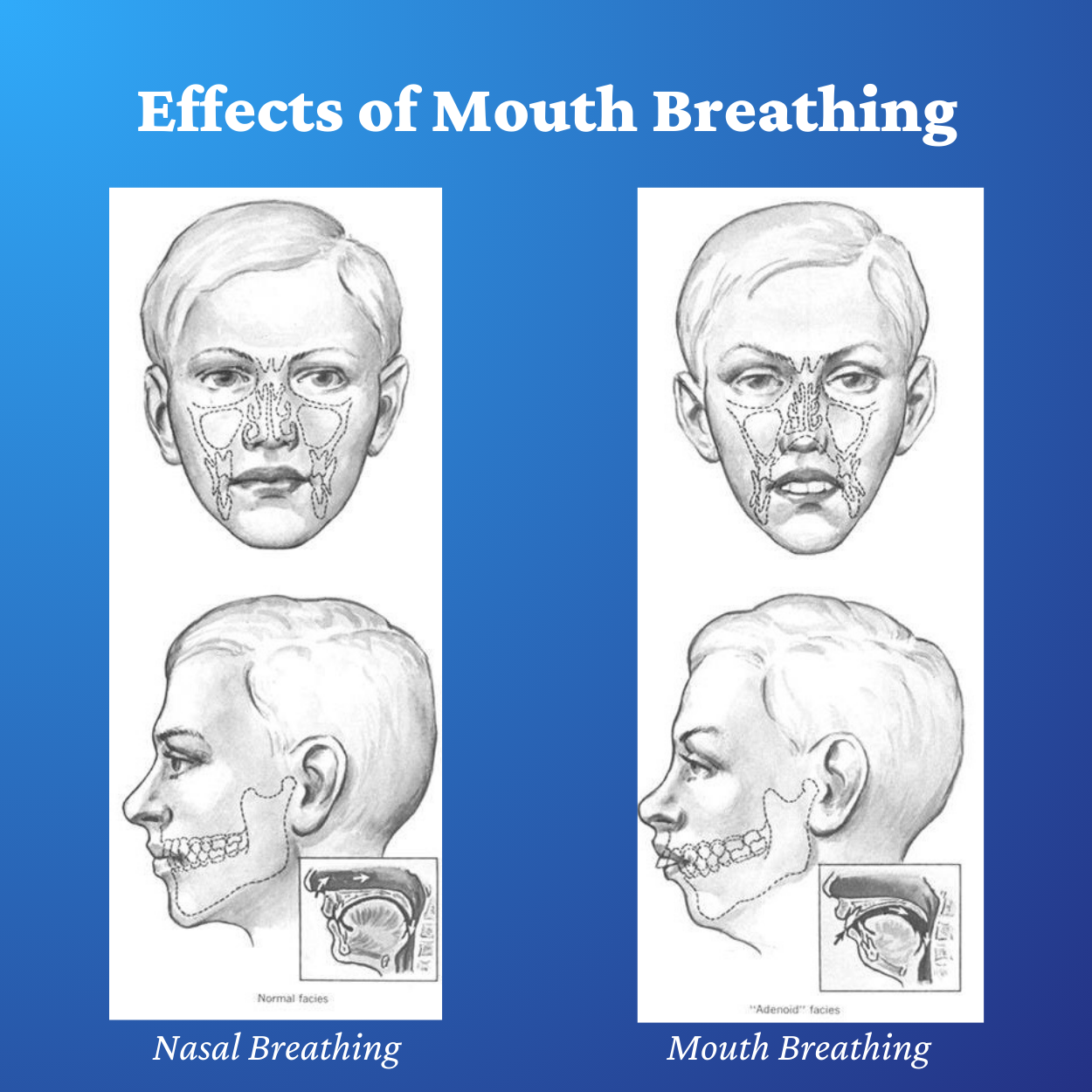 Nasal Strips - Performance Strips for Optimal Breathing